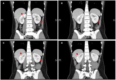 A Case Report and Literature Review of Mesalazine-Induced Kidney Injury in a Pediatric Patient With Ulcerative Colitis